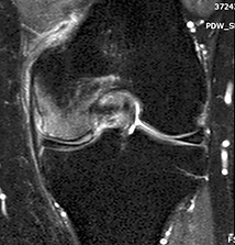 edema-21-287x300.png