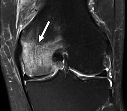 EDEMA-ÓSEO.jpg
