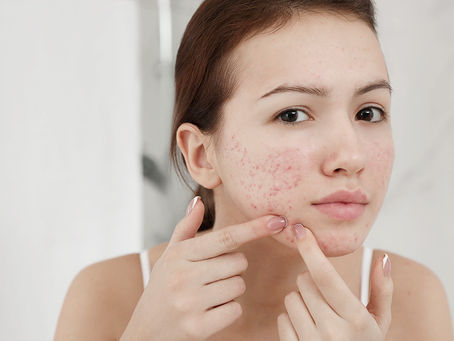 Why adults have acne?