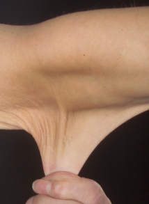 Ehlers-Danlos Syndrome