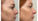 Laser Resurfacing Recovery Time: What To Expect