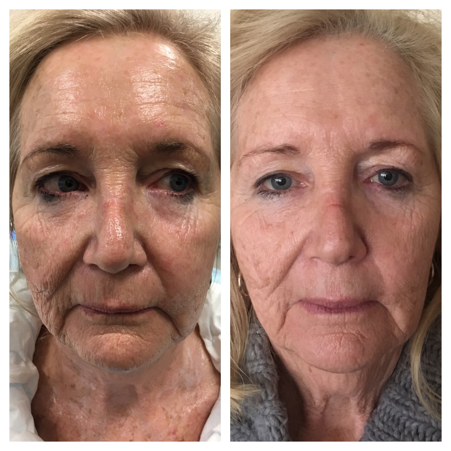 collagen induction therapy near me