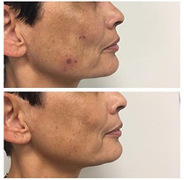 Pigmentation Spot Laser Removal Before and After Medical Skin and Laser.jpg