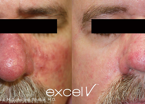 excel V_532_Vascular_4.jpg