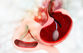 Intra Gastric Balloon (1).png