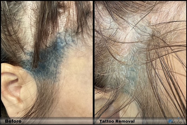 Tattoo Removal Result