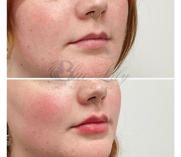 Lip filler.JPEG