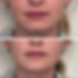 Chin shadowing and chin