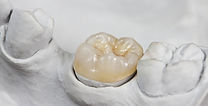 Modèle d’implant dentaire intégré dans un dentier artificiel, présenté dans un cabinet au Luxembourg.