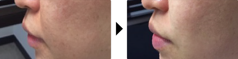 Cheek and mouth area before and after Liftera Cool treatment demonstrating enhanced facial contour and reduced nasolabial fol