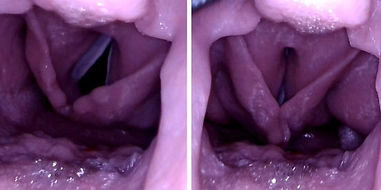 Airway Management Task Trainer V2 - adjustable vocal cords for simulating laryngospasm and unilateral vocal cord paralysis.