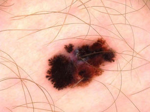 What Does an Early Melanoma Look Like?