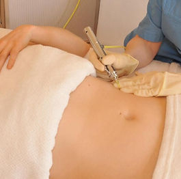 zur Behandlung von Cellulitis und bei lokalisierten Fettdepots erfolgreich durchgeführt Gesichtsfalten Unterlidfalten Dehnungsstreifen, Schwangerschaftsstrei