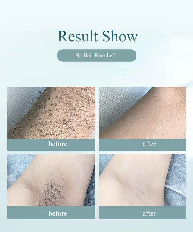 Thumbnail: Professional Permanent Laser Depilator IPL Hair Removal For Whole Body, Depilato