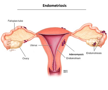 Endometriotic Disease