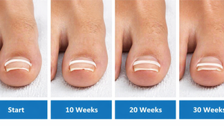 Onyfix Ingrown Toenail Treatment in Southampton, PA