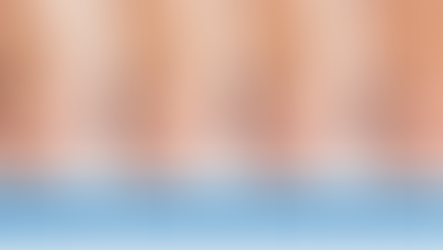 Onyfix Ingrown Toenail Treatment in Southampton, PA