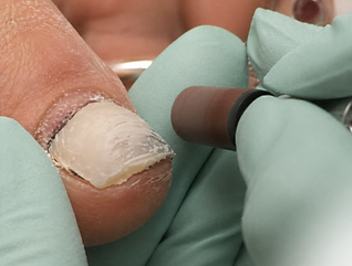 keryflex-toenail-restoration