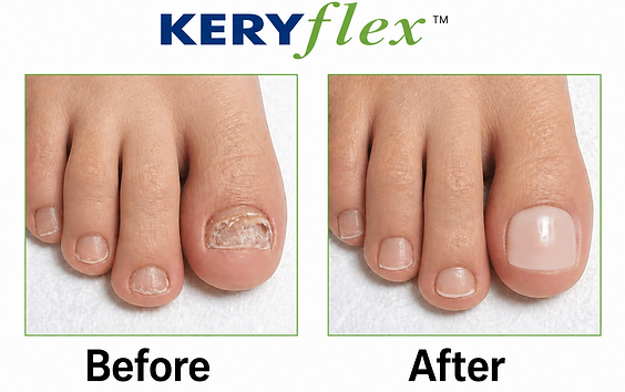 KeryFlex toenail restoration before and after result