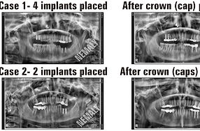 CONVENTIONAL IMPLANTS.jpg