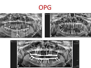 OPG