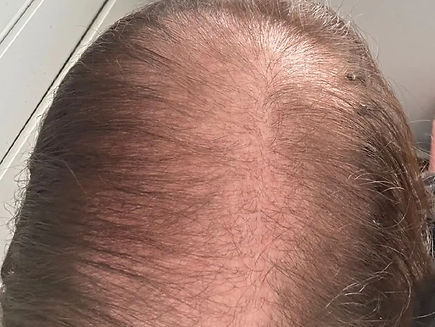Top view of thinning hair and fragile strands, showing areas of reduced density before treatment