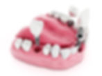 dental implants