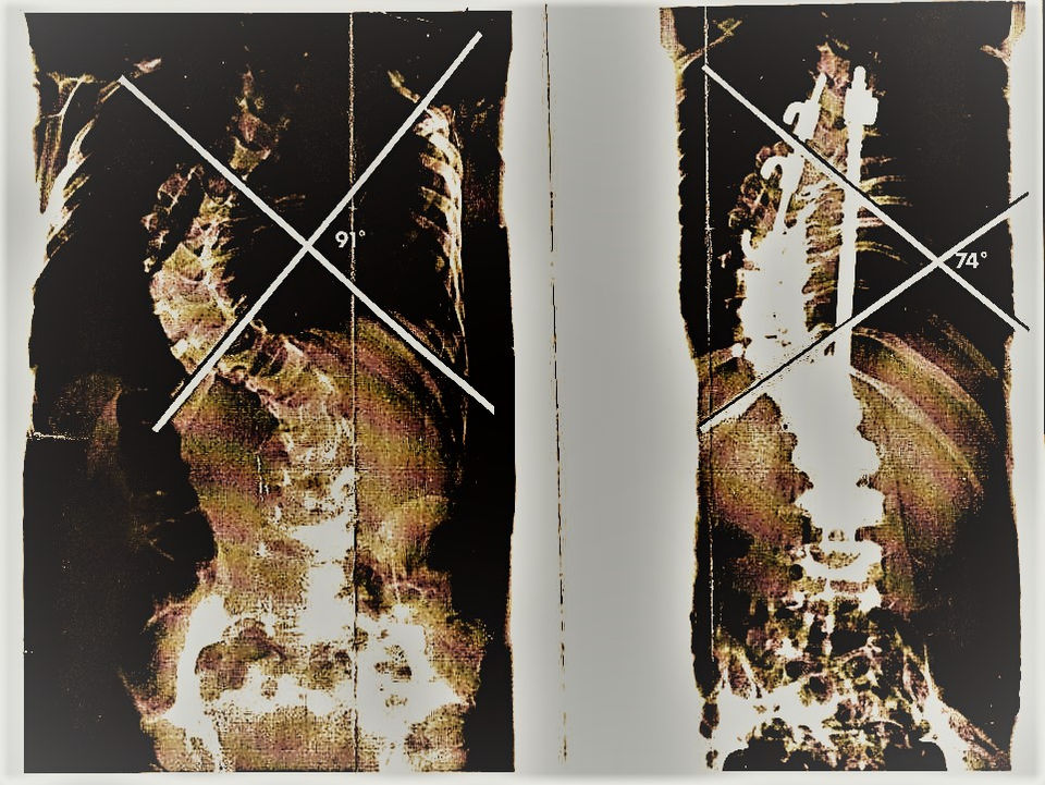 RIKXECOM X RAY 1 CONTRAST 