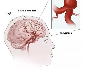 BEYİN ANEVRİZMALARI