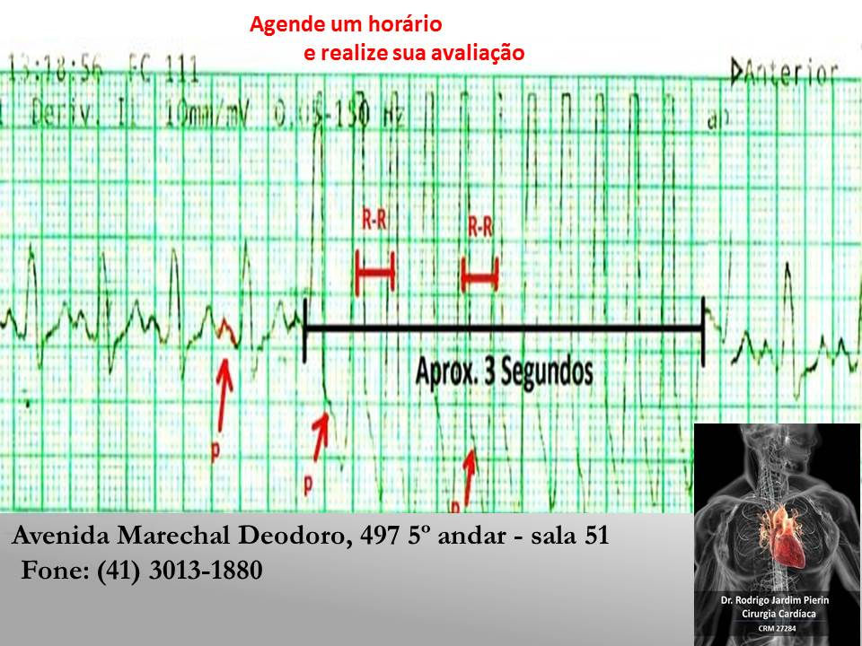 Alterações Inespecíficas Da Repolarização Ventricular Sintomas