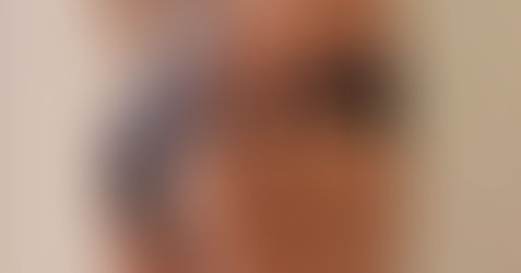 Mengapa Stretch Mark Susah Nak Hilang?