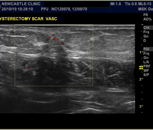 Ultrasound of C-section scar