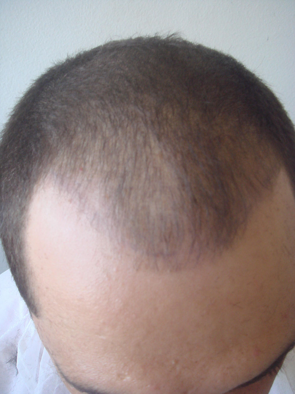 antes