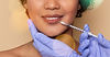 Close-up of a person receiving a cosmetic injection in their lips