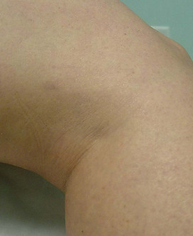laser skin resurfacing treatment spider vein after snoqualmie north bend issaquah sammamish