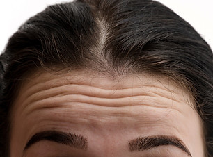 Forehead_wrinkles_medium_edited.jpg