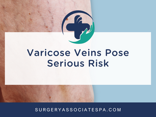 Varicose Veins Pose Serious Rish