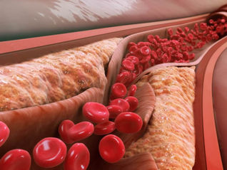 Atheroma