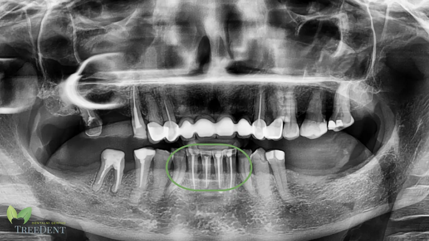 endodoncija-nakon.webp