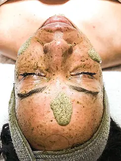 Green Peel Treatment