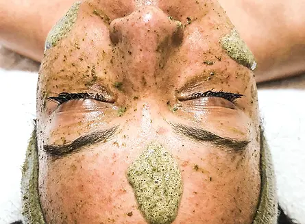 Green Peel  Treatment