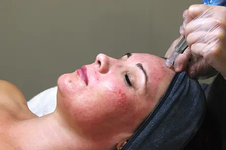 Microneedling