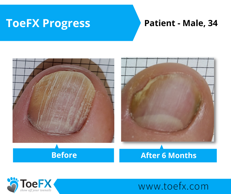 ToeFx Progress Picture 5