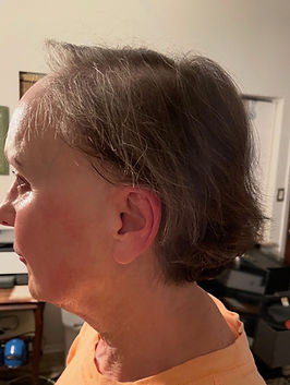 Client facing hair loss from Frontal Fibrosing Alopecia