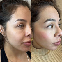 Before and after prp dermagel at Esse Med Spa in Denver, Colorado