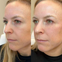 Before and after prp dermagel at Esse Med Spa in Denver, Colorado