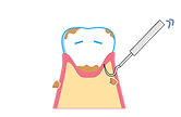 歯石除去イラスト