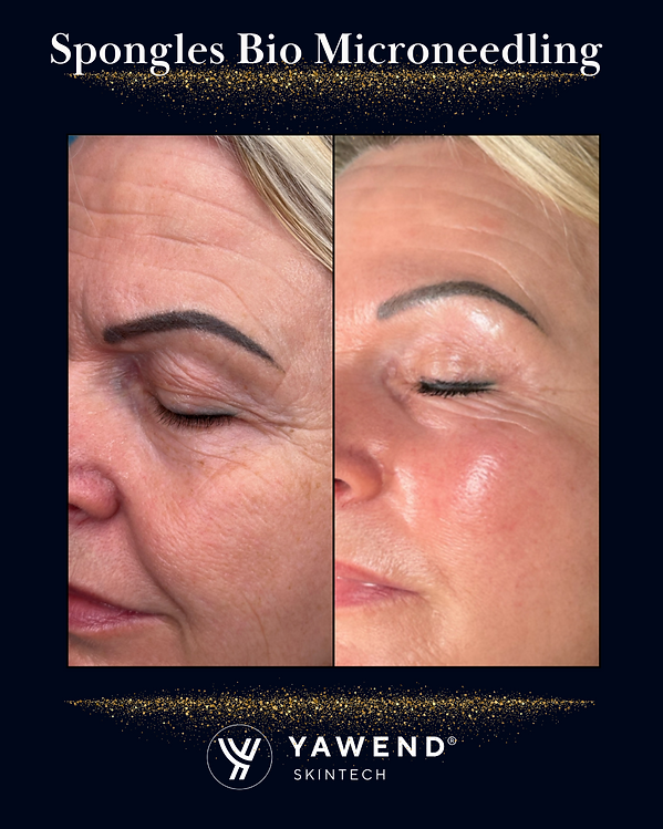 Kopie von Spongles Bio Microneedling.png