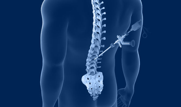 Spinal Instrumentations & Spinal Fusion Surgeries