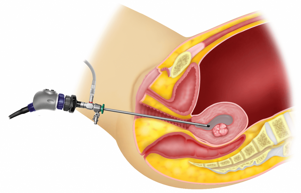 Diagnostic-Hysteroscopy